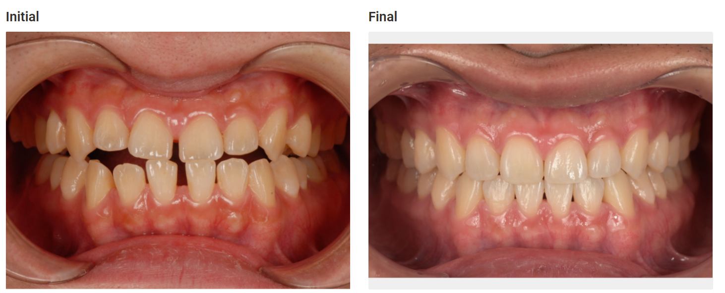 Gap between teeth closed with aligners in Patna - before and after